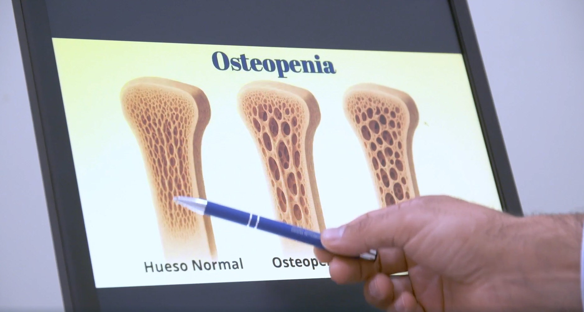 Osteopenia 