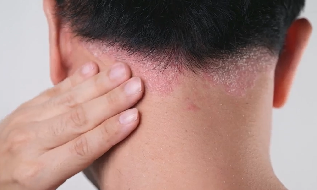 Psoriasis