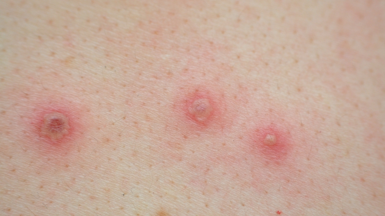 zoonosis