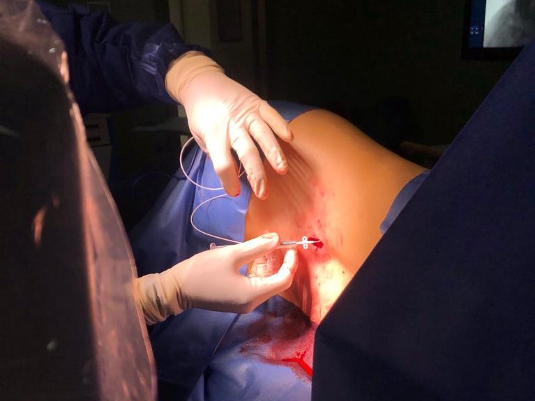 implantes intratecales