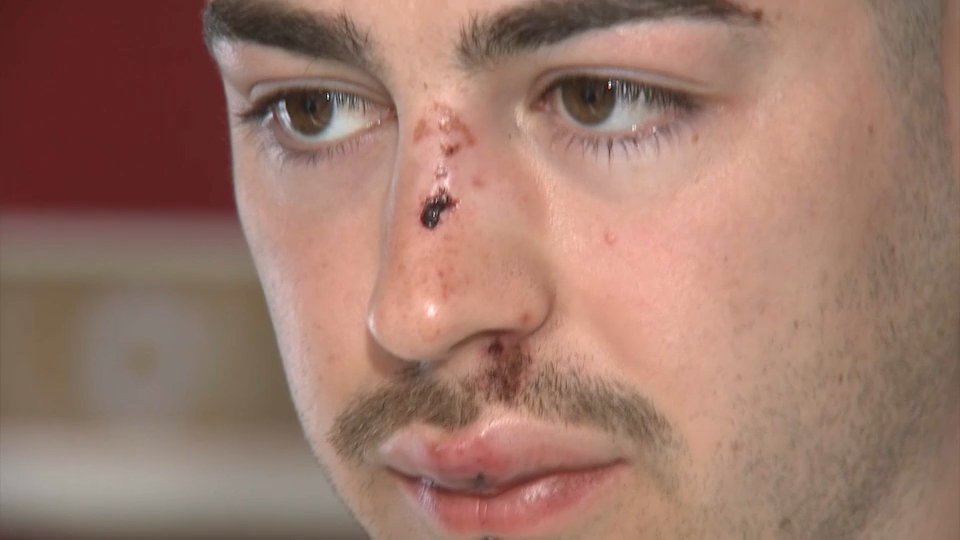 Carlos Zambrano, joven denunciante, muestra sus heridas