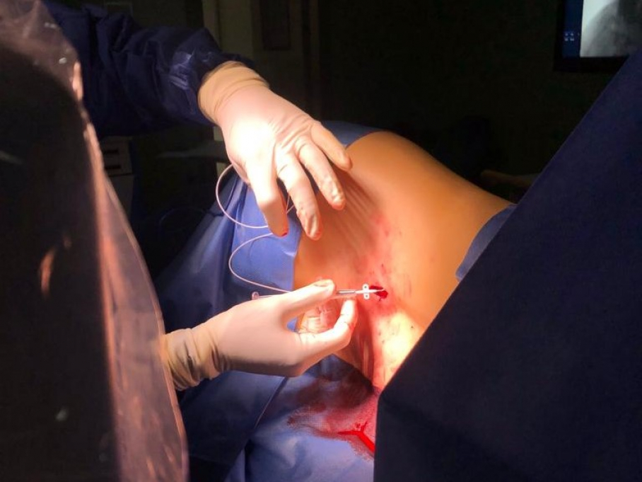 implantes intratecales