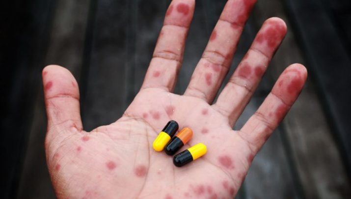 Mano de un niño con escarlatina
