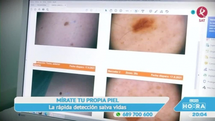 melanoma prevención