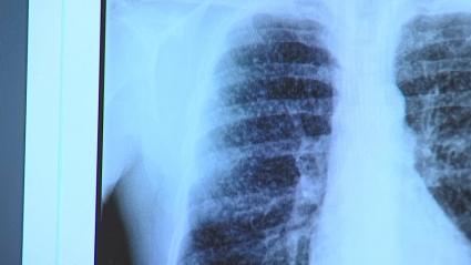 Pulmones afectados por silicosis