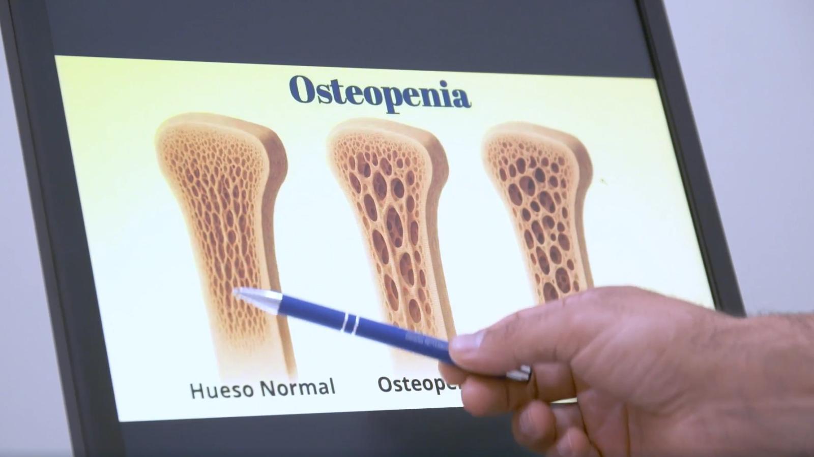 Osteopenia 