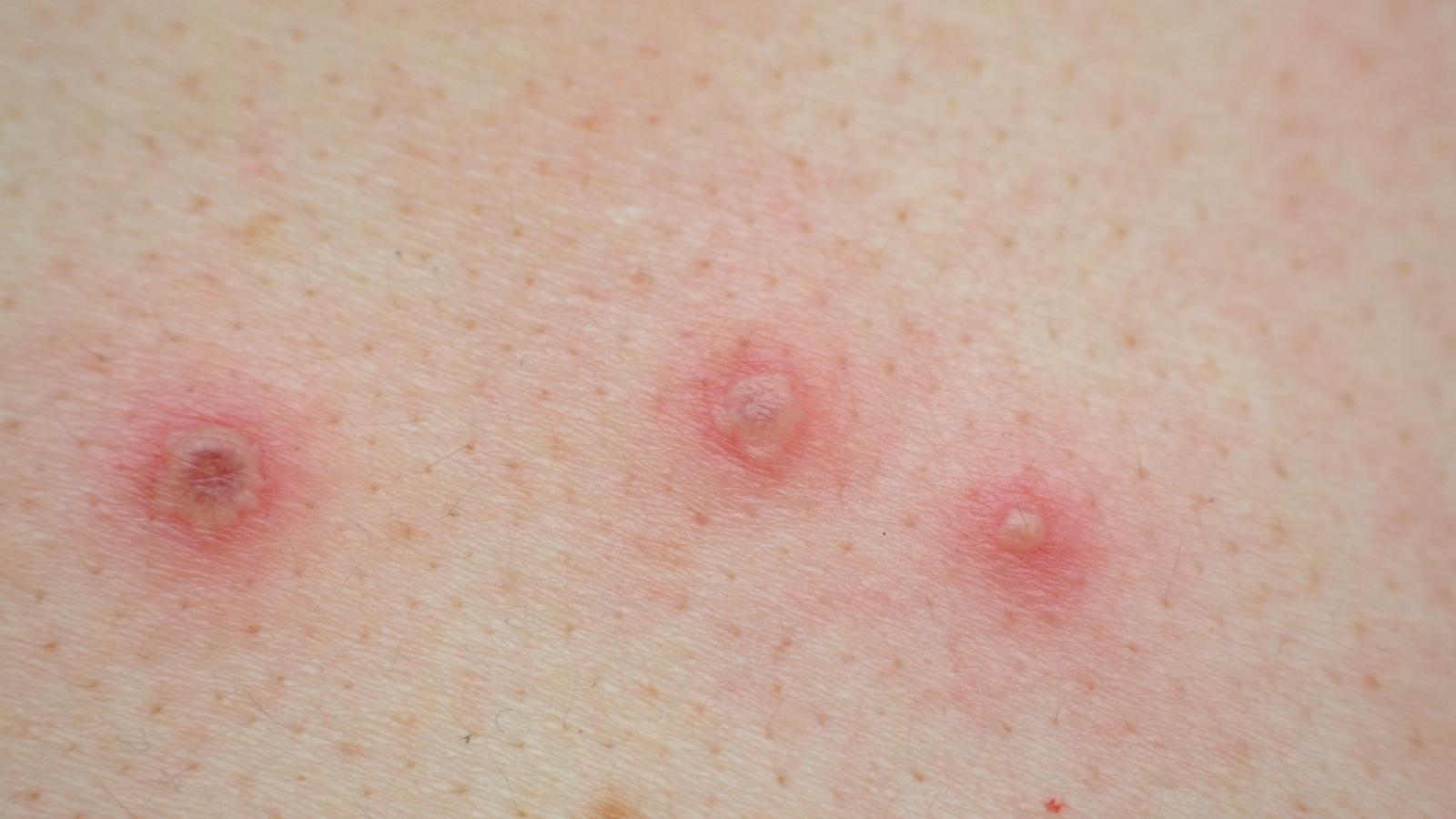 zoonosis