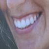 Blancorexia, mania por los dientes blancos