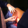 implantes intratecales